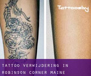 Tattoo verwijdering in Robinson Corner (Maine)