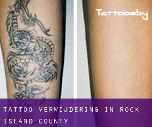Tattoo verwijdering in Rock Island County