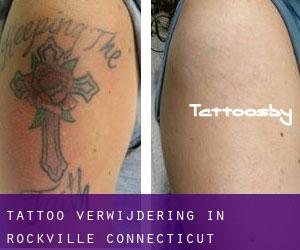 Tattoo verwijdering in Rockville (Connecticut)