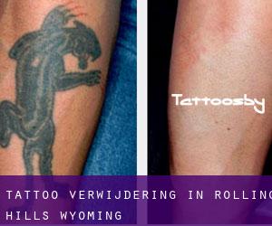 Tattoo verwijdering in Rolling Hills (Wyoming)