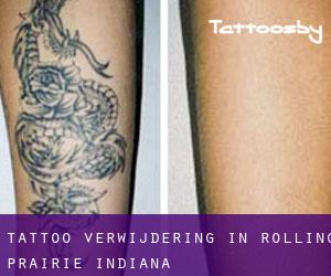 Tattoo verwijdering in Rolling Prairie (Indiana)