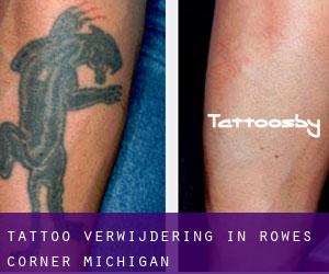 Tattoo verwijdering in Rowes Corner (Michigan)