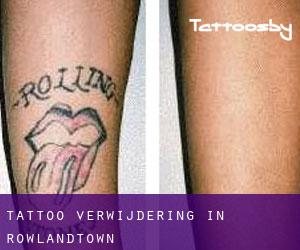 Tattoo verwijdering in Rowlandtown