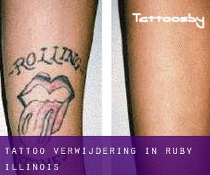 Tattoo verwijdering in Ruby (Illinois)