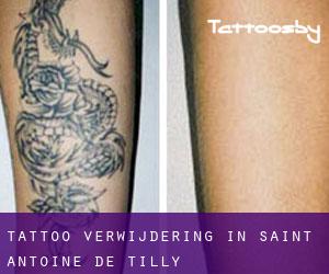 Tattoo verwijdering in Saint-Antoine-de-Tilly
