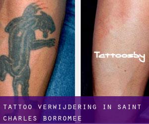 Tattoo verwijdering in Saint-Charles-Borromée