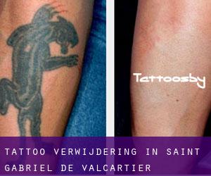 Tattoo verwijdering in Saint-Gabriel-de-Valcartier