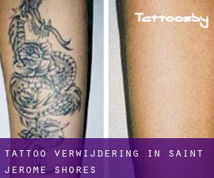 Tattoo verwijdering in Saint Jerome Shores