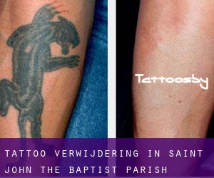 Tattoo verwijdering in Saint John the Baptist Parish