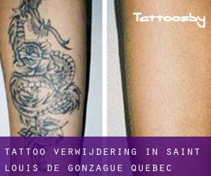 Tattoo verwijdering in Saint-Louis-de-Gonzague (Quebec)