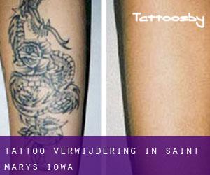 Tattoo verwijdering in Saint Marys (Iowa)
