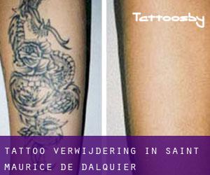Tattoo verwijdering in Saint-Maurice-de-Dalquier