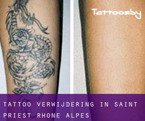 Tattoo verwijdering in Saint-Priest (Rhône-Alpes)