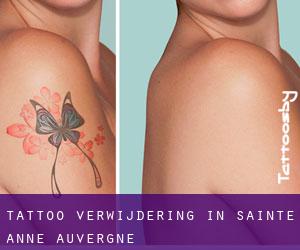 Tattoo verwijdering in Sainte-Anne (Auvergne)