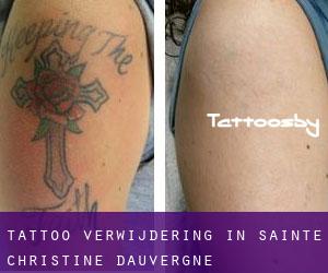Tattoo verwijdering in Sainte-Christine-d'Auvergne