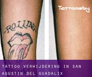 Tattoo verwijdering in San Agustín del Guadalix