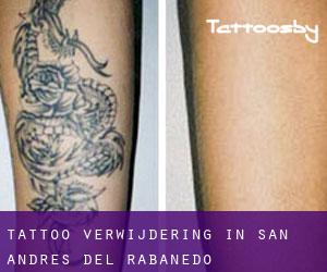 Tattoo verwijdering in San Andrés del Rabanedo