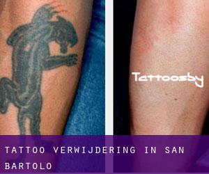 Tattoo verwijdering in San Bartolo