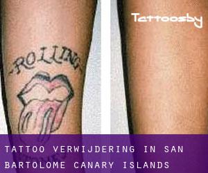 Tattoo verwijdering in San Bartolomé (Canary Islands)