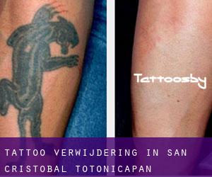 Tattoo verwijdering in San Cristóbal Totonicapán