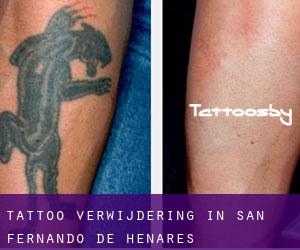 Tattoo verwijdering in San Fernando de Henares
