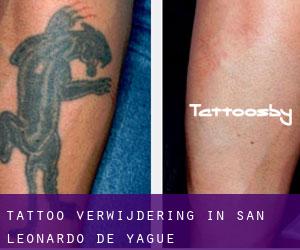 Tattoo verwijdering in San Leonardo de Yagüe