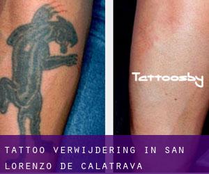 Tattoo verwijdering in San Lorenzo de Calatrava