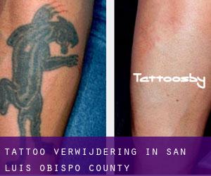 Tattoo verwijdering in San Luis Obispo County