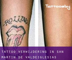 Tattoo verwijdering in San Martín de Valdeiglesias