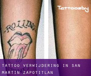 Tattoo verwijdering in San Martín Zapotitlán