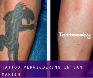 Tattoo verwijdering in San Martín