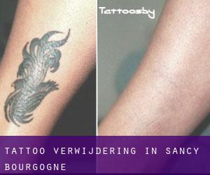 Tattoo verwijdering in Sancy (Bourgogne)