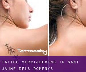 Tattoo verwijdering in Sant Jaume dels Domenys