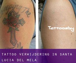 Tattoo verwijdering in Santa Lucia del Mela