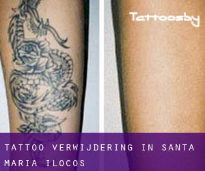 Tattoo verwijdering in Santa Maria (Ilocos)