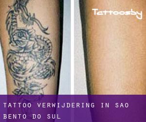 Tattoo verwijdering in São Bento do Sul