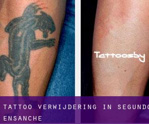 Tattoo verwijdering in Segundo Ensanche