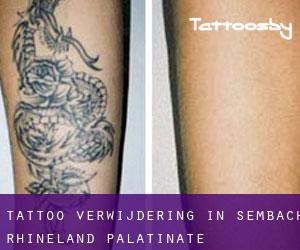 Tattoo verwijdering in Sembach (Rhineland-Palatinate)