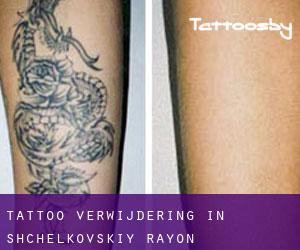 Tattoo verwijdering in Shchëlkovskiy Rayon