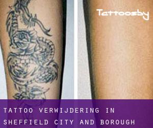 Tattoo verwijdering in Sheffield (City and Borough)