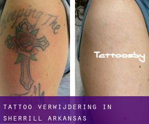 Tattoo verwijdering in Sherrill (Arkansas)