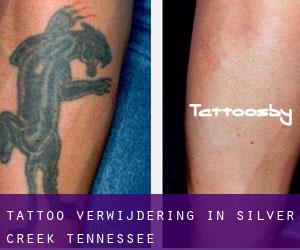 Tattoo verwijdering in Silver Creek (Tennessee)