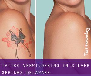 Tattoo verwijdering in Silver Springs (Delaware)