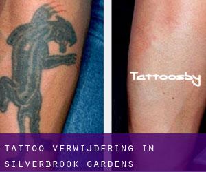 Tattoo verwijdering in Silverbrook Gardens
