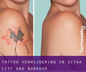 Tattoo verwijdering in Sitka City and Borough