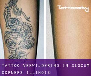 Tattoo verwijdering in Slocum Corners (Illinois)