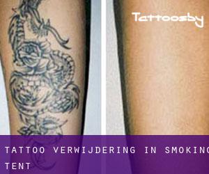 Tattoo verwijdering in Smoking Tent