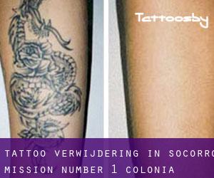 Tattoo verwijdering in Socorro Mission Number 1 Colonia