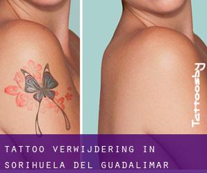 Tattoo verwijdering in Sorihuela del Guadalimar