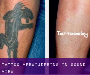 Tattoo verwijdering in Sound View